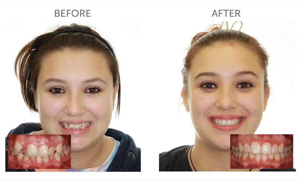 Invisalign Hornchurch Essex before and after treatment