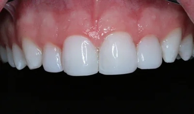 After Invisalign and Harrow Dental