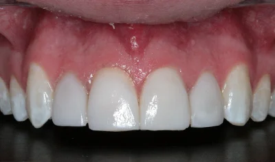 After Invisalign and Harrow Dental