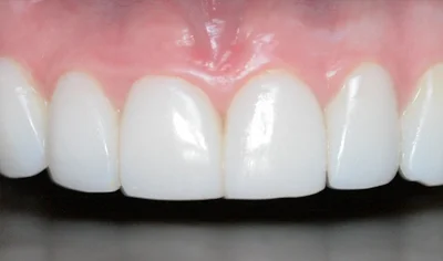 After Invisalign and Harrow Dental