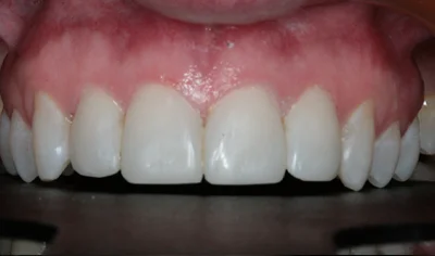After Invisalign and Harrow Dental