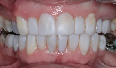 After Invisalign and Harrow Dental