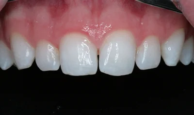 Before Invisalign and Harrow Dental