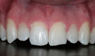 Before Invisalign and Harrow Dental