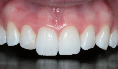 Before Invisalign and Harrow Dental