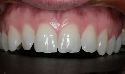Before Invisalign and Harrow Dental
