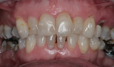 Before Invisalign and Harrow Dental