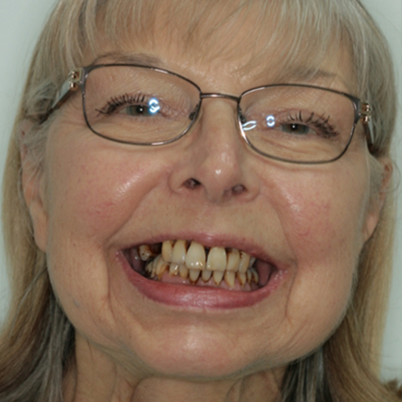 Before Dental Implants in Hornchurch