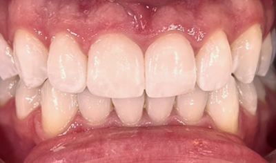 After Invisalign and Harrow Dental