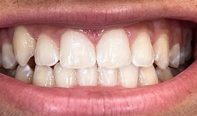 After Invisalign and Harrow Dental