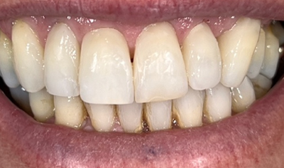 After Invisalign and Harrow Dental