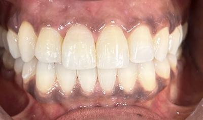 After Invisalign and Harrow Dental