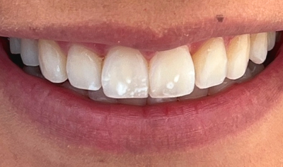 After Invisalign and Harrow Dental