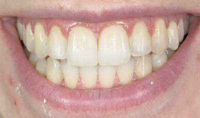 After Invisalign and Harrow Dental