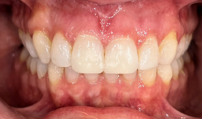 After Invisalign and Harrow Dental