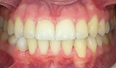 After Invisalign and Harrow Dental