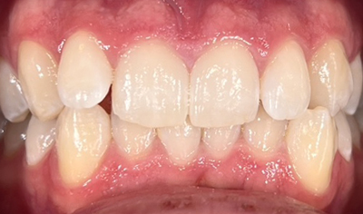 Before Invisalign and Harrow Dental