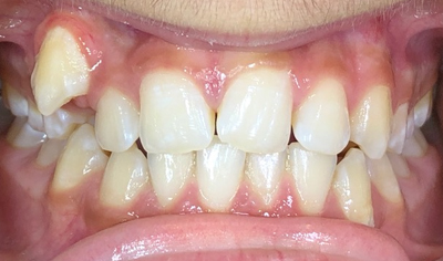 Before Invisalign and Harrow Dental