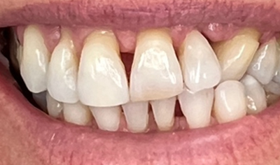 Before Invisalign and Harrow Dental