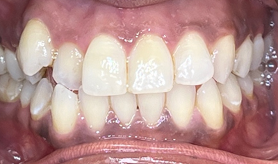 Before Invisalign and Harrow Dental