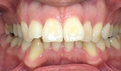 Before Invisalign and Harrow Dental