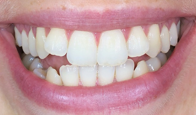 Before Invisalign and Harrow Dental