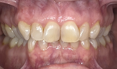 Before Invisalign and Harrow Dental