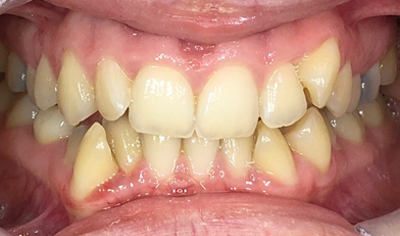 Before Invisalign and Harrow Dental