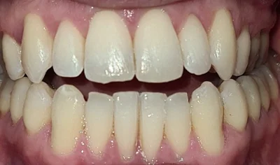 After Invisalign and Harrow Dental