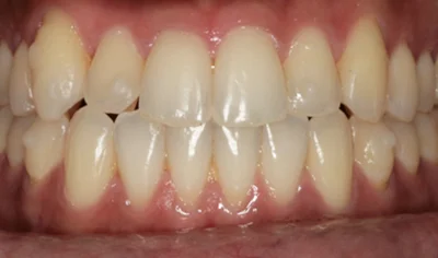 After Invisalign and Harrow Dental