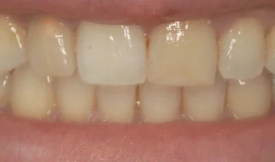 After Invisalign and Harrow Dental