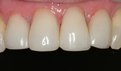 Before Invisalign and Harrow Dental