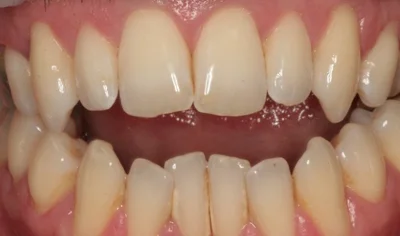 Before Invisalign and Harrow Dental