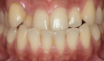 Before Invisalign and Harrow Dental