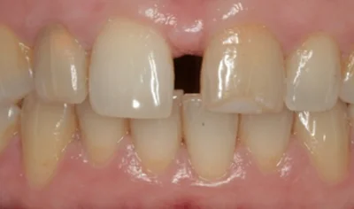 Before Invisalign and Harrow Dental