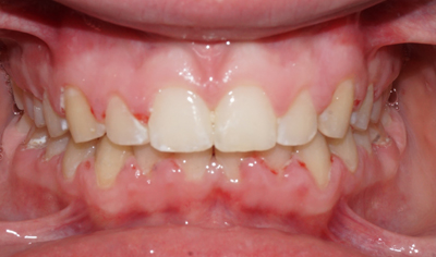 After Fixed Orthodontic treatment at Harrow Dental