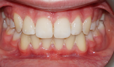 After Fixed Orthodontic treatment at Harrow Dental
