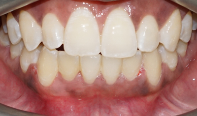 After Fixed Orthodontic treatment at Harrow Dental