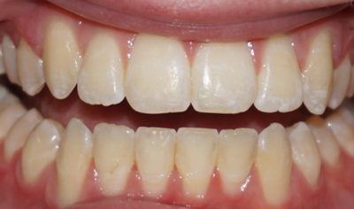 After Fixed Orthodontic treatment at Harrow Dental