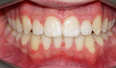 After Fixed Orthodontic treatment at Harrow Dental