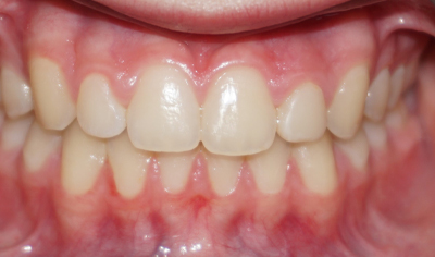 After Fixed Orthodontic treatment at Harrow Dental