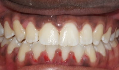 After Fixed Orthodontic treatment at Harrow Dental