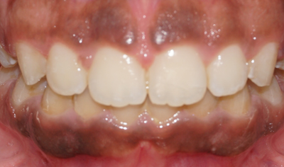 After Fixed Orthodontic treatment at Harrow Dental