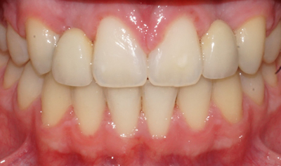 After Fixed Orthodontic treatment at Harrow Dental
