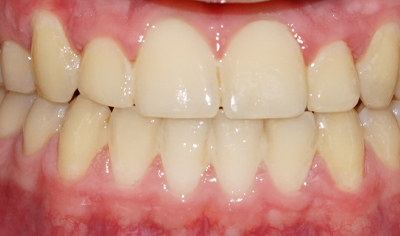 After Fixed Orthodontic treatment at Harrow Dental