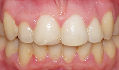 After Fixed Orthodontic treatment at Harrow Dental