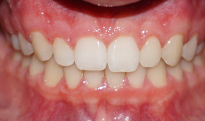 After Fixed Orthodontic treatment at Harrow Dental