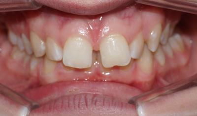 Before Fixed Orthodontic treatment at Harrow Dental