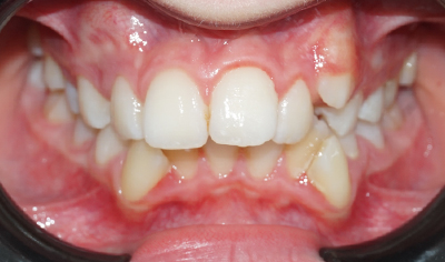 Before Fixed Orthodontic treatment at Harrow Dental
