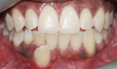 Before Fixed Orthodontic treatment at Harrow Dental